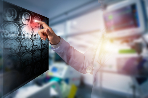 Experimental Gene Therapy Shields Brain from Toxic Protein Damage