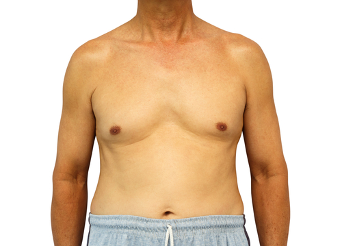 Meet the men getting breast reductions — which is now the most popular plastic surgery among guys in the US